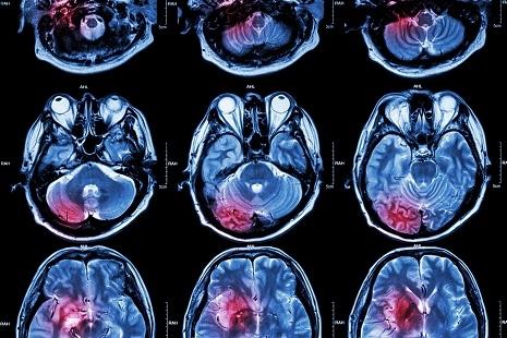 MRI may Safely Allow TPA Treatment to Increase Undetected Stroke Patients