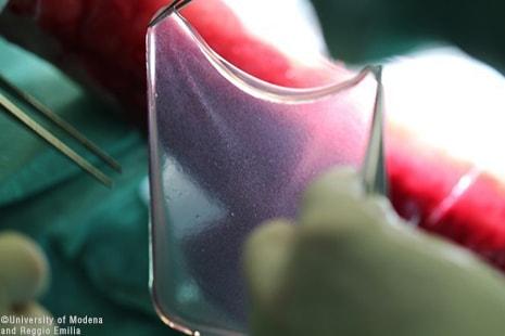 Skin Regrown With Stem Cell Treatments after Deadly Skin Disease Diagnosis